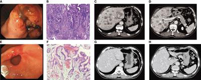 Hepatic arterial infusion chemotherapy and trastuzumab in gastric cancer with liver metastases: a case report